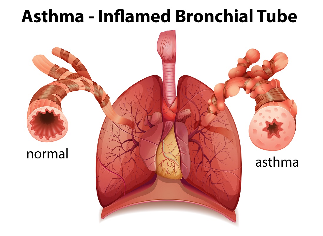бронхиальная астма
