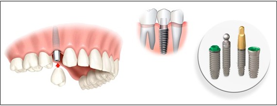 Имплантация зубов